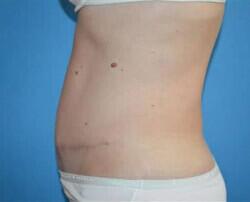 Tummy Tuck Before & After Image