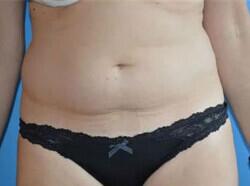 Tummy Tuck Before & After Image