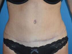 Tummy Tuck Before & After Image