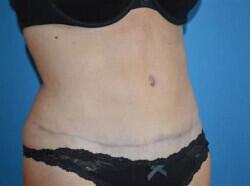 Tummy Tuck Before & After Image