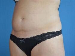 Tummy Tuck Before & After Image