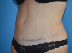 Tummy Tuck Before & After Image