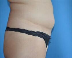 Tummy Tuck Before & After Image