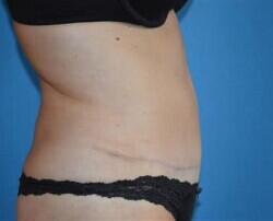 Tummy Tuck Before & After Image