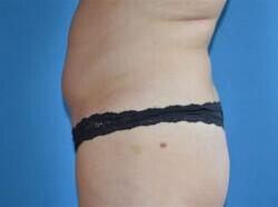 Tummy Tuck Before & After Image