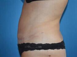 Tummy Tuck Before & After Image