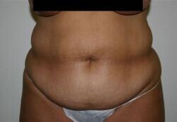 Tummy Tuck Before & After Image