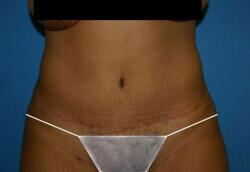 Tummy Tuck Before & After Image