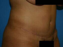 Tummy Tuck Before & After Image