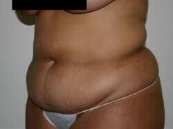 Tummy Tuck Before & After Image