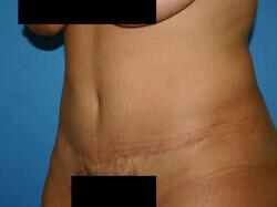 Tummy Tuck Before & After Image