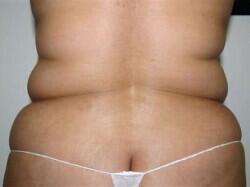 Tummy Tuck Before & After Image