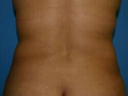 Tummy Tuck Before & After Image