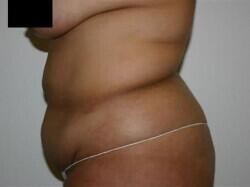 Tummy Tuck Before & After Image