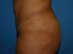 Tummy Tuck Before & After Image