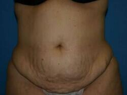 Tummy Tuck Before & After Image