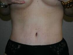 Tummy Tuck Before & After Image