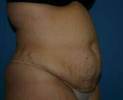 Tummy Tuck Before & After Image