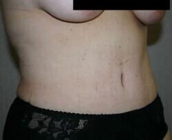 Tummy Tuck Before & After Image