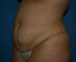 Tummy Tuck Before & After Image