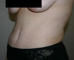 Tummy Tuck Before & After Image