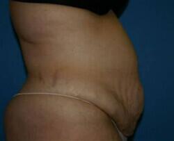 Tummy Tuck Before & After Image