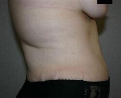 Tummy Tuck Before & After Image