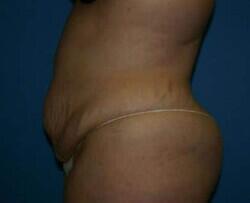Tummy Tuck Before & After Image