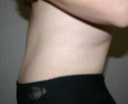 Tummy Tuck Before & After Image
