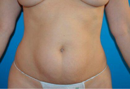 Tummy Tuck Before & After Image