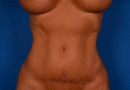 Tummy Tuck Before & After Image