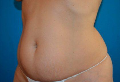 Tummy Tuck Before & After Image