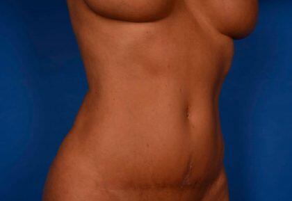 Tummy Tuck Before & After Image