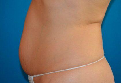 Tummy Tuck Before & After Image