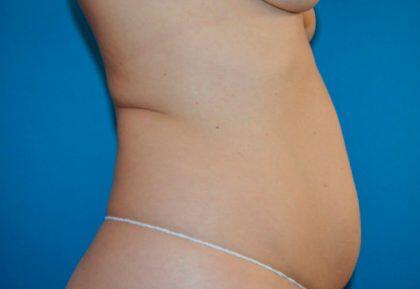 Tummy Tuck Before & After Image