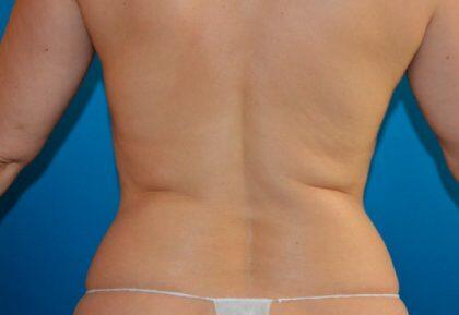 Tummy Tuck Before & After Image