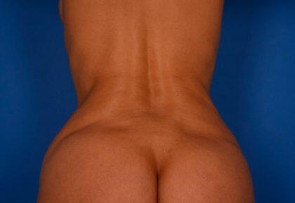 Tummy Tuck Before & After Image