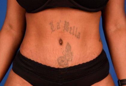 Tummy Tuck Before & After Image