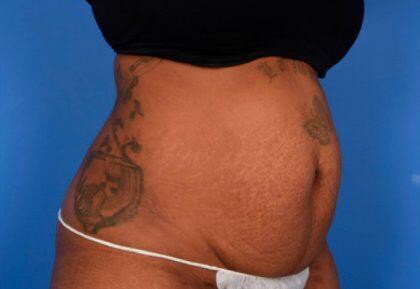 Tummy Tuck Before & After Image