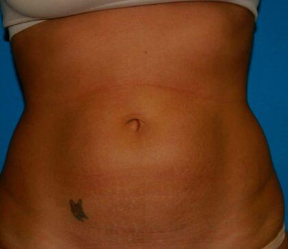 Tummy Tuck Before & After Image