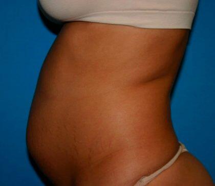 Tummy Tuck Before & After Image