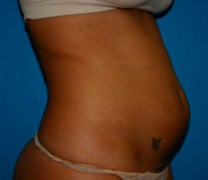 Tummy Tuck Before & After Image