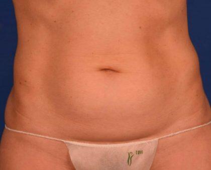 Tummy Tuck Before & After Image