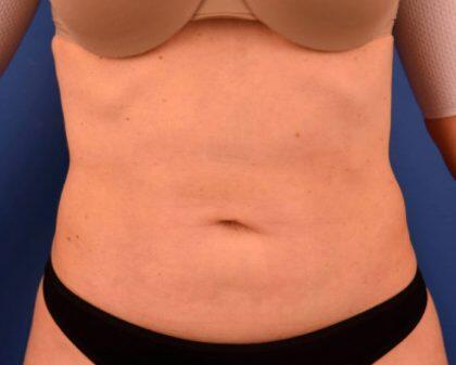 Tummy Tuck Before & After Image