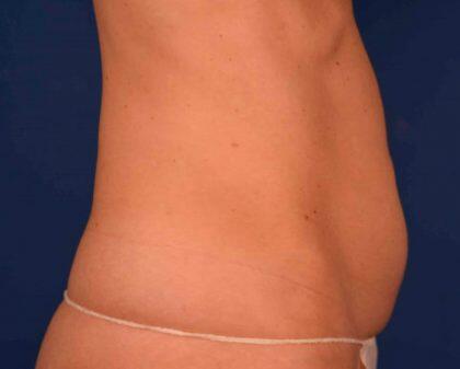 Tummy Tuck Before & After Image