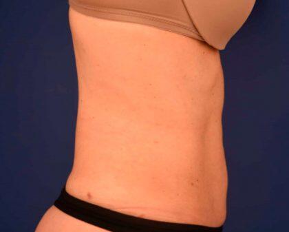 Tummy Tuck Before & After Image