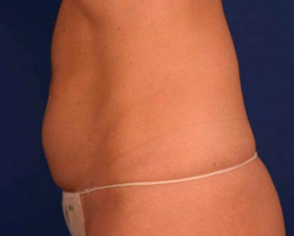 Tummy Tuck Before & After Image