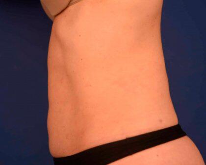 Tummy Tuck Before & After Image