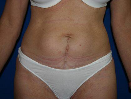 Tummy Tuck Before & After Image