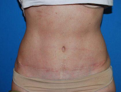 Tummy Tuck Before & After Image